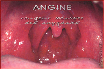 Angine Streptococcique